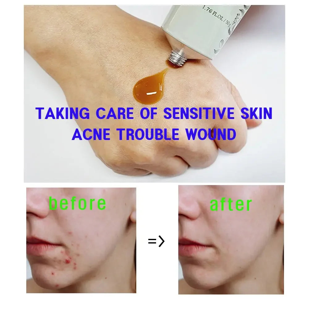 Korean skincare cream for sensitive skin, acne treatment before and after results