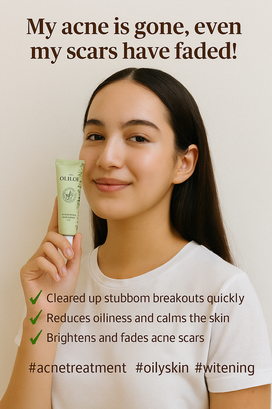 [Review] Olioe Acne Care – Real Results for Teen Sensitive Skin!